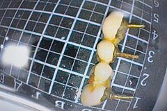 У россиянки в кишечнике застрял зубной протез