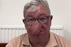 Врачи прооперировали не целовавшегося с женой из-за большого носа мужчину