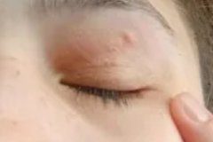 Из глаза девушки удалили 11-сантиметрового червя